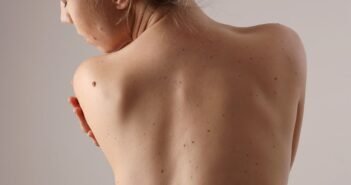 பிறப்புறுப்பில் உண்டாகும் மரு – காரணமும் தீர்வும்! | #VisualStory